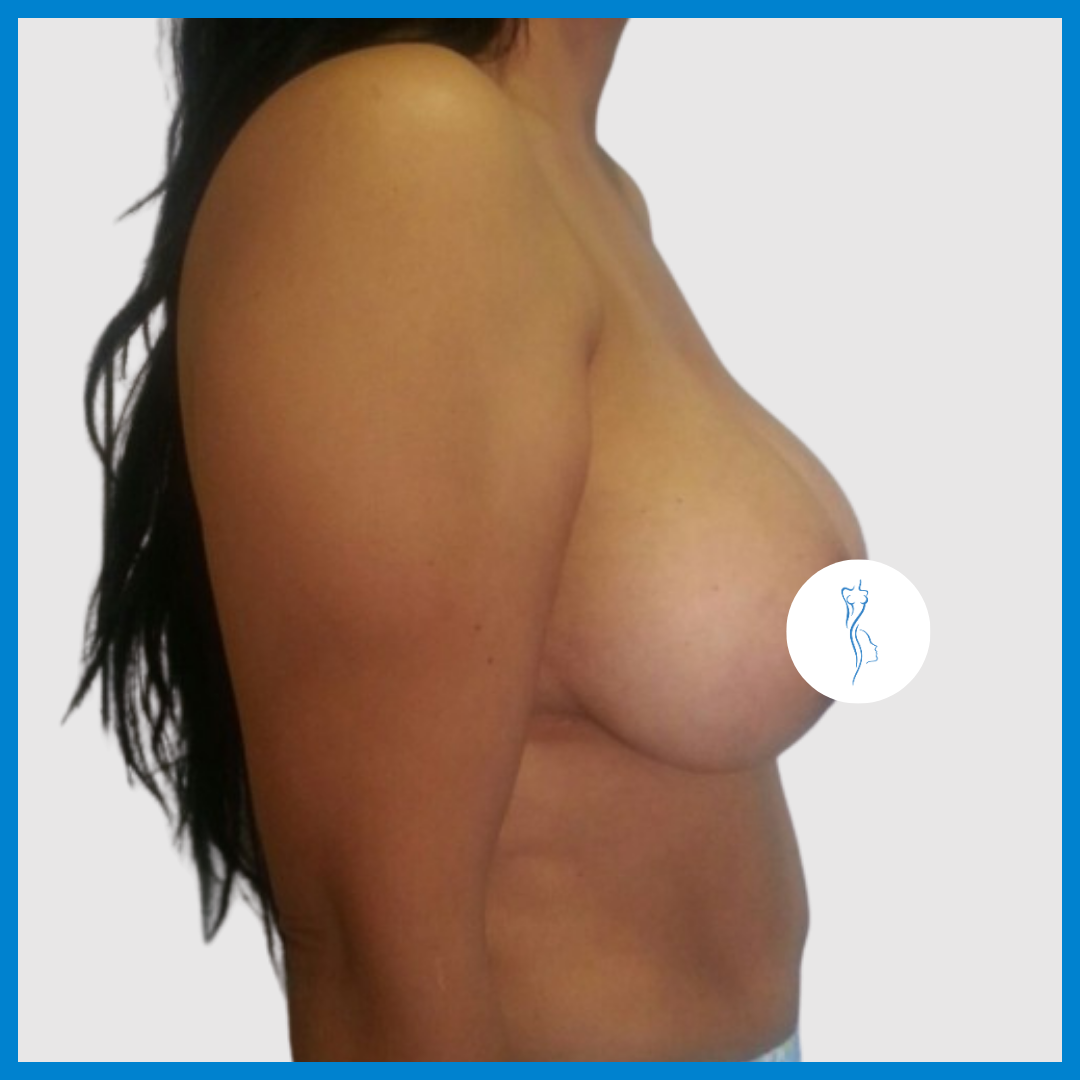 Before-Mastopexia