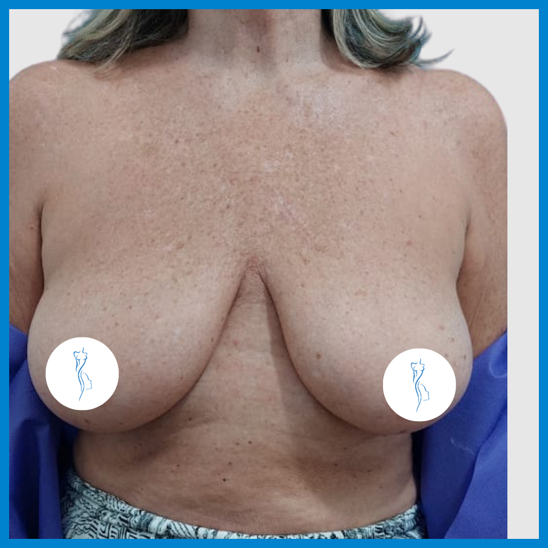 Before-Mastopexia