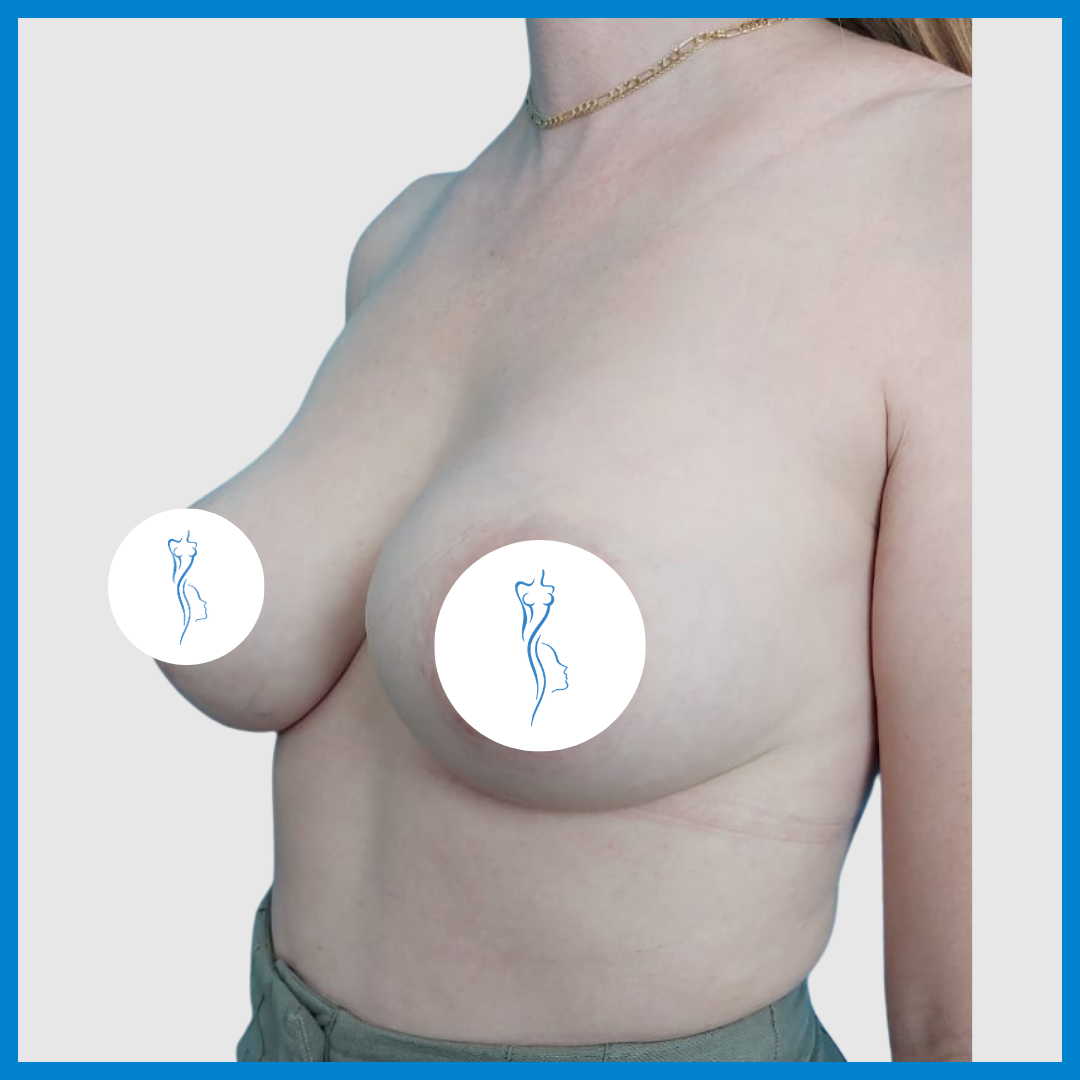 Before-Mastopexia