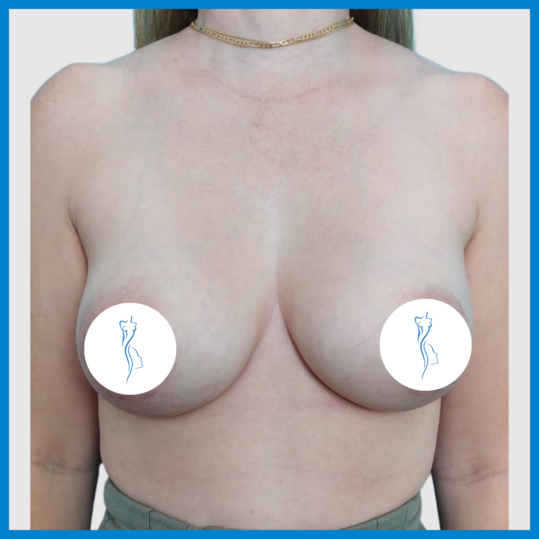 Before-Mastopexia