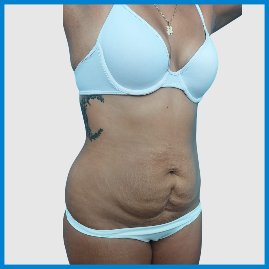 Before- Abdominoplastia