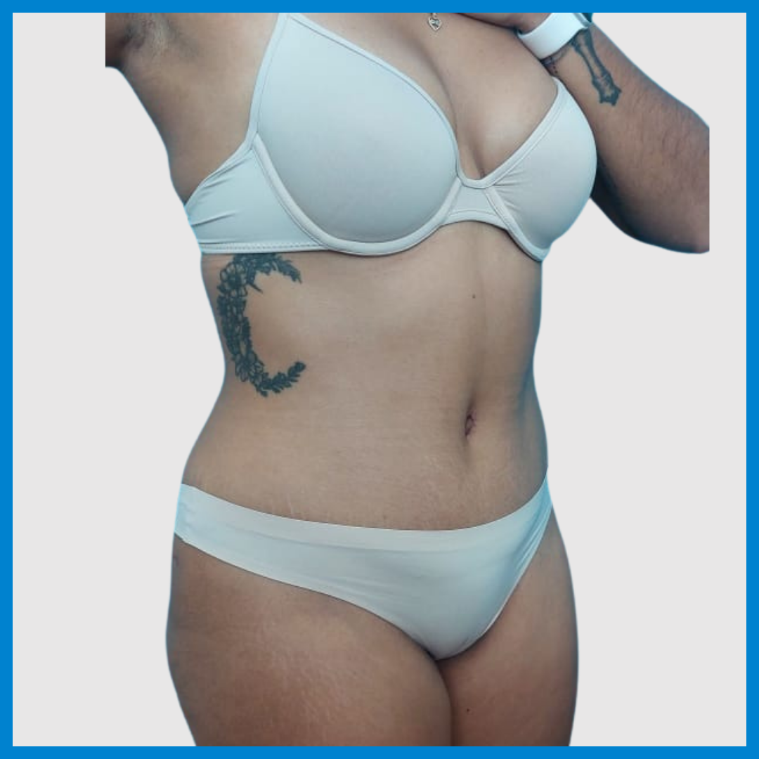 After- Abdominoplastia