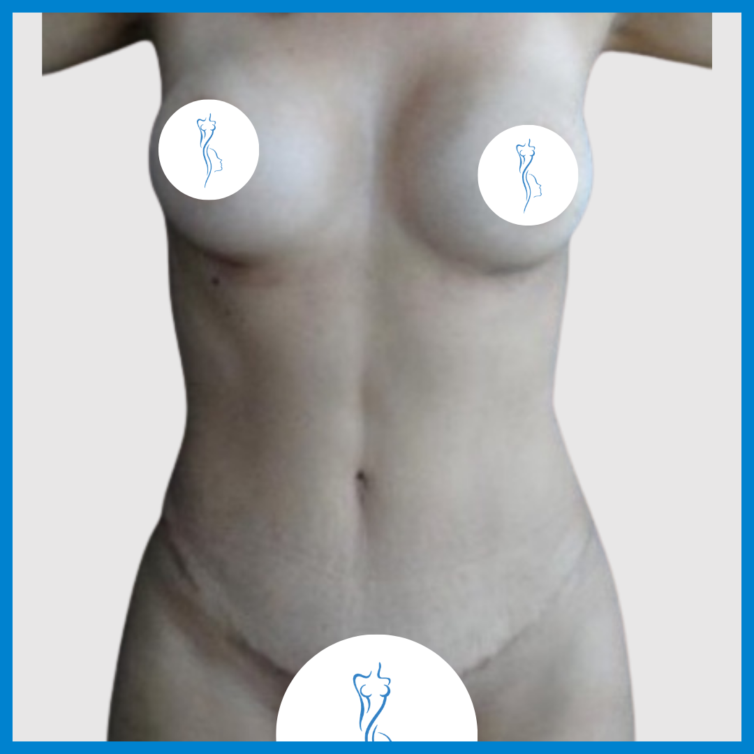 After- Abdominoplastia