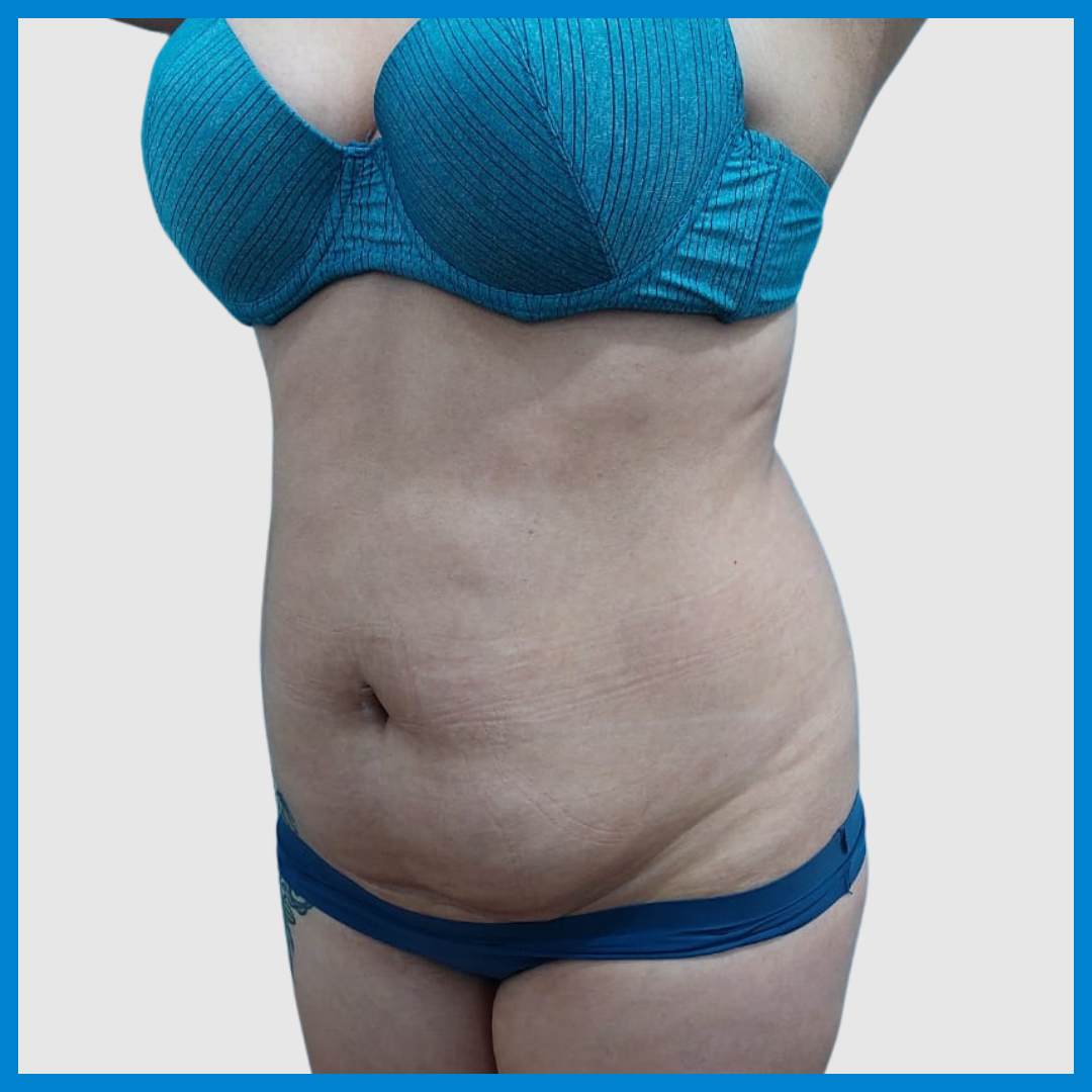 Before- Abdominoplastia