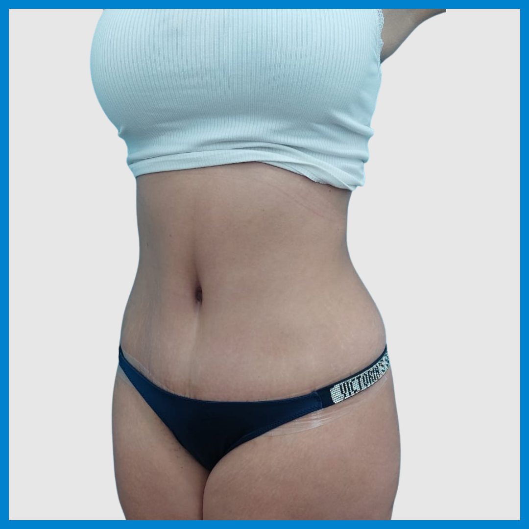 After- Abdominoplastia