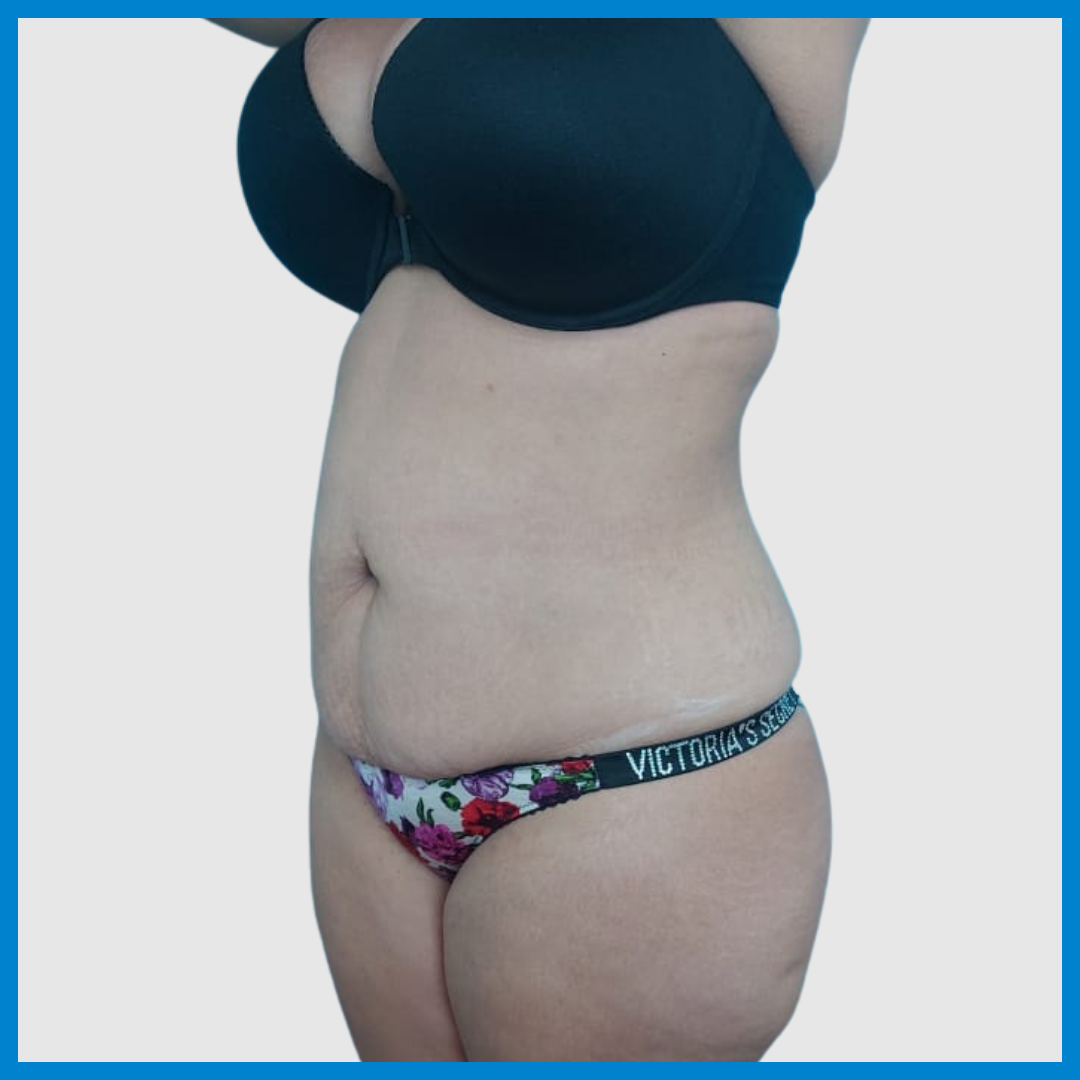 Before- Abdominoplastia