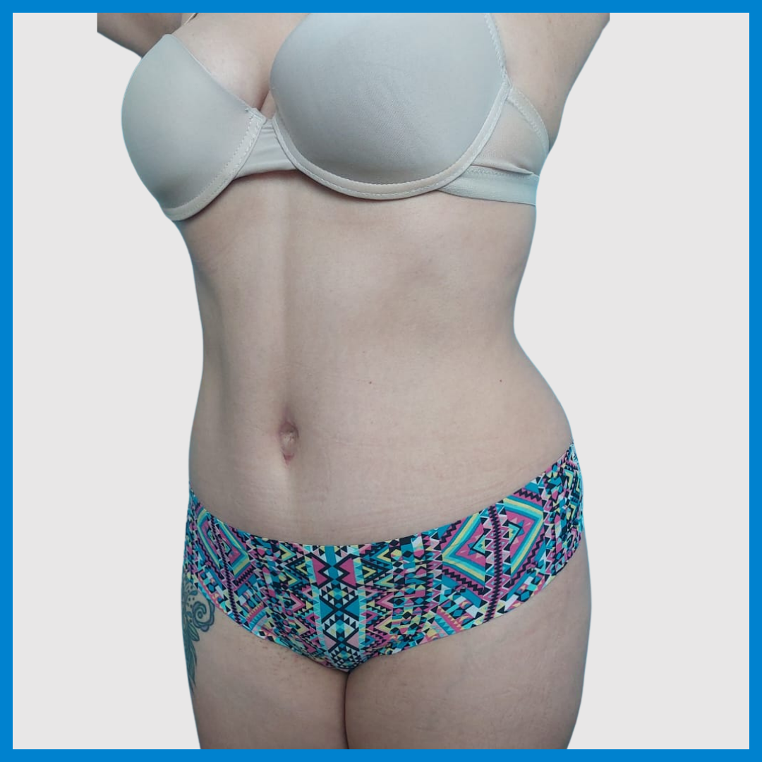 After- Abdominoplastia