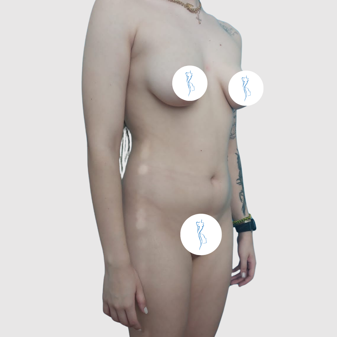 Before-Lipoescultura