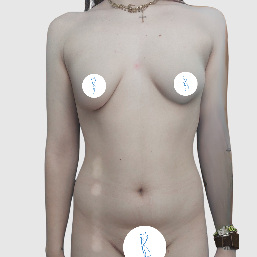 Before- Lipoescultura