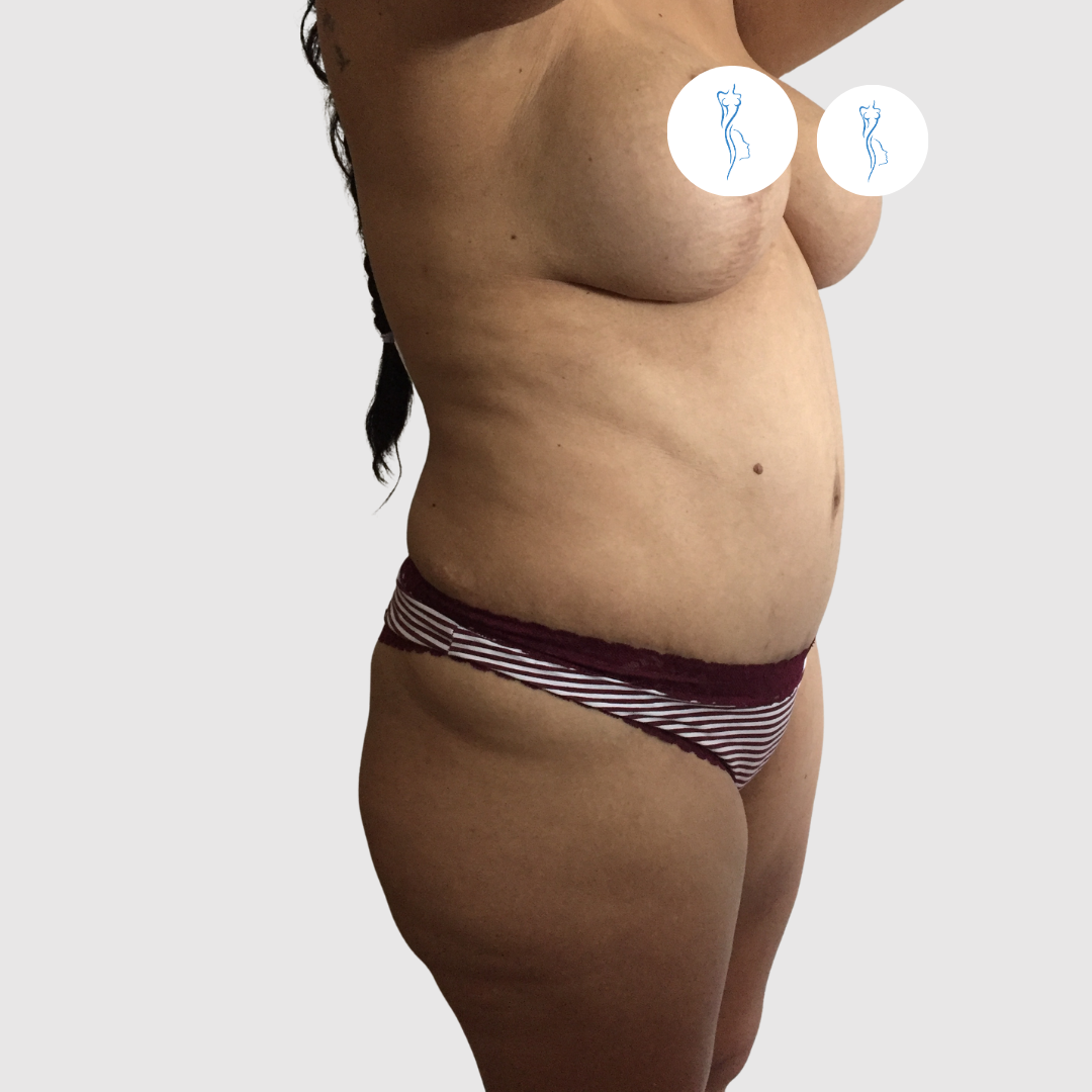Before- Lipoescultura