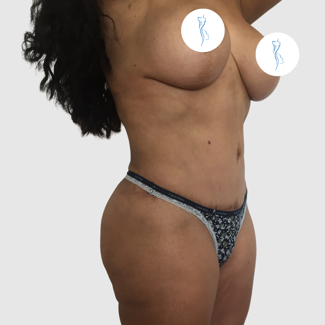After- Lipoescultura