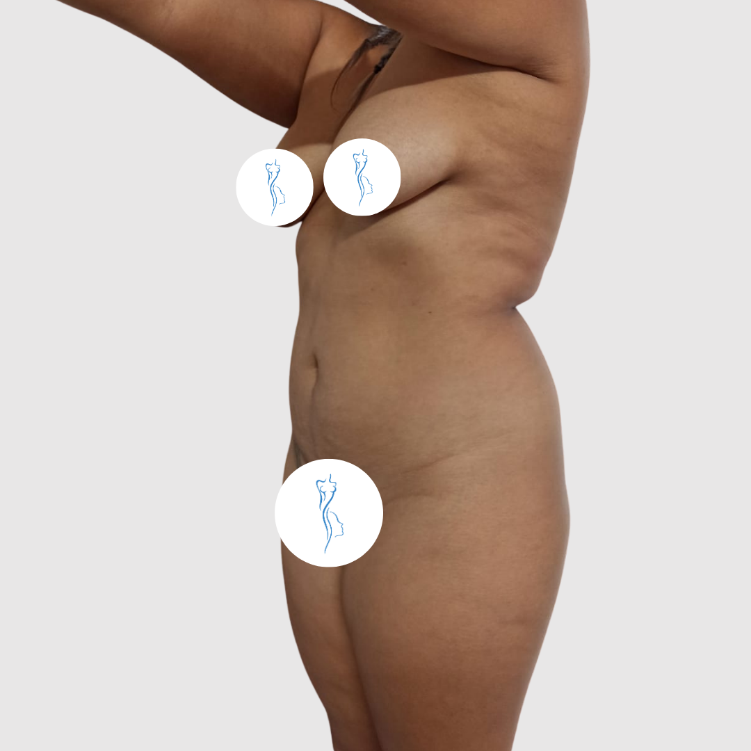 Before- Lipoescultura