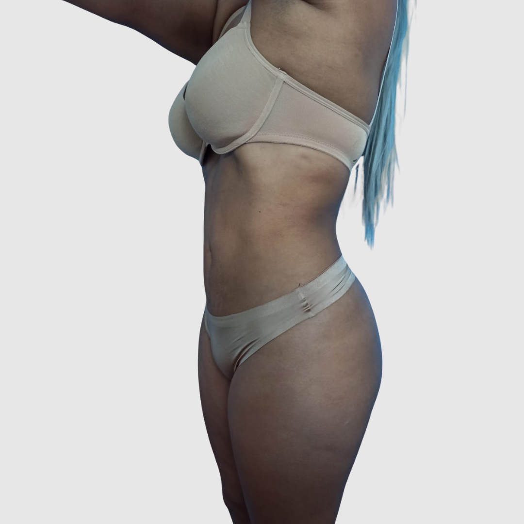 After- Lipoescultura