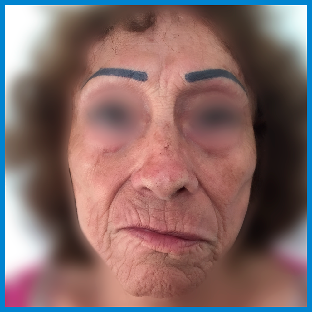 Before- Lipoinyección Facial