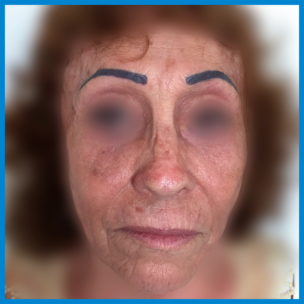 After- Lipoinyección Facial