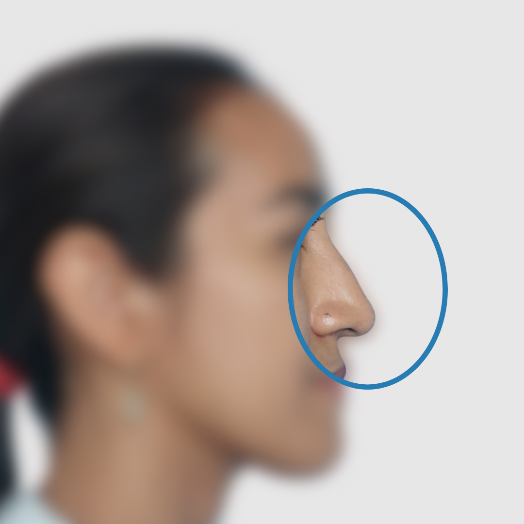 Before-Rinoplastia