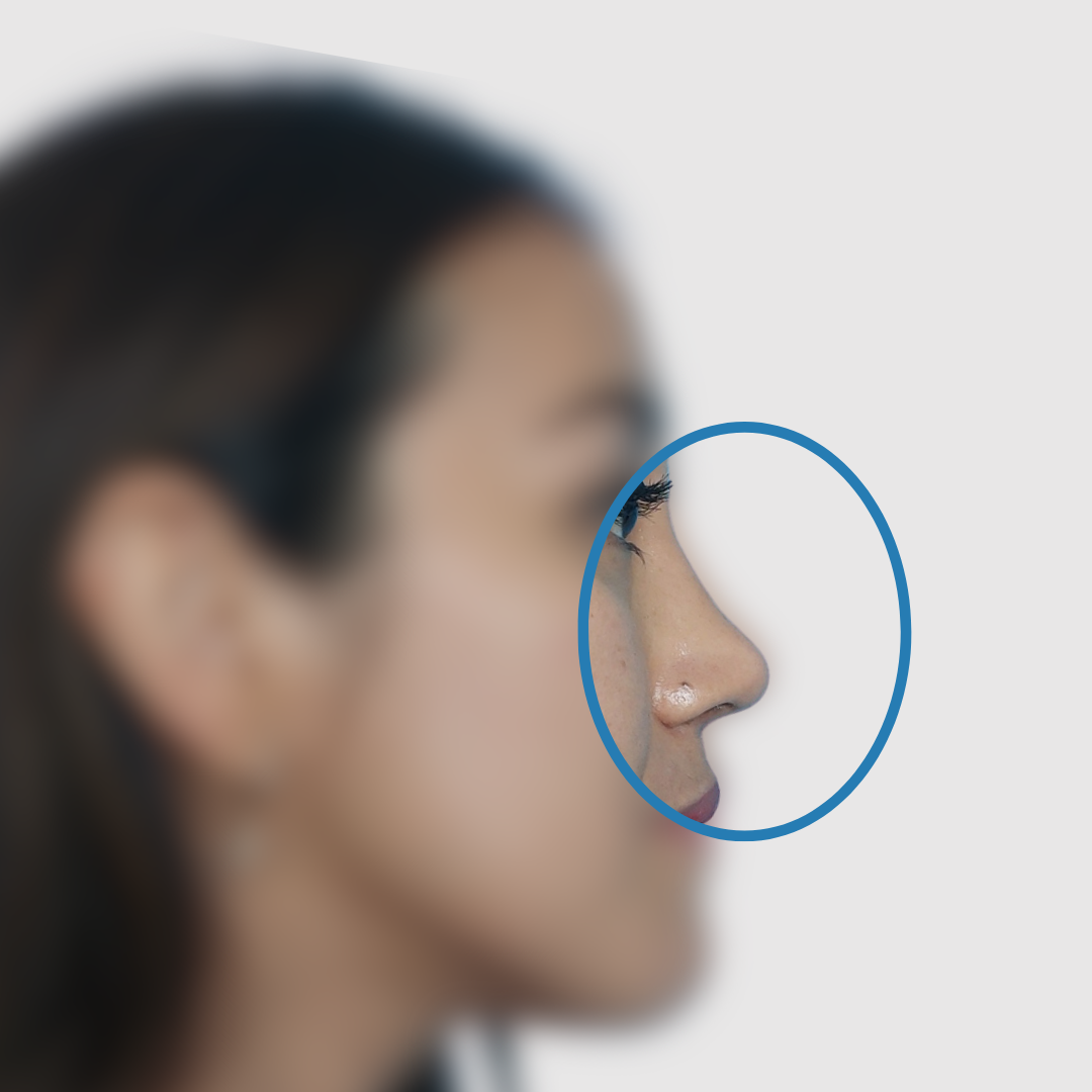 After-Rinoplastia