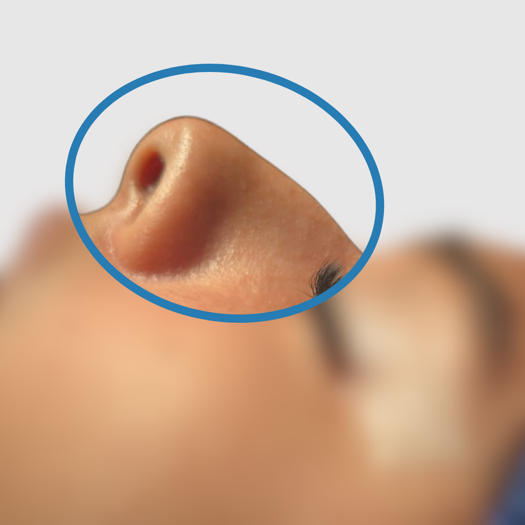 Before-Rinoplastia