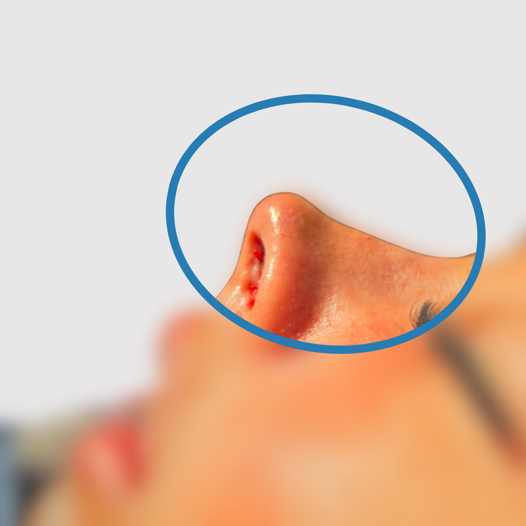 After-Rinoplastia