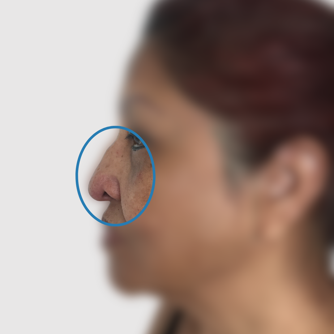 Before-Rinoplastia