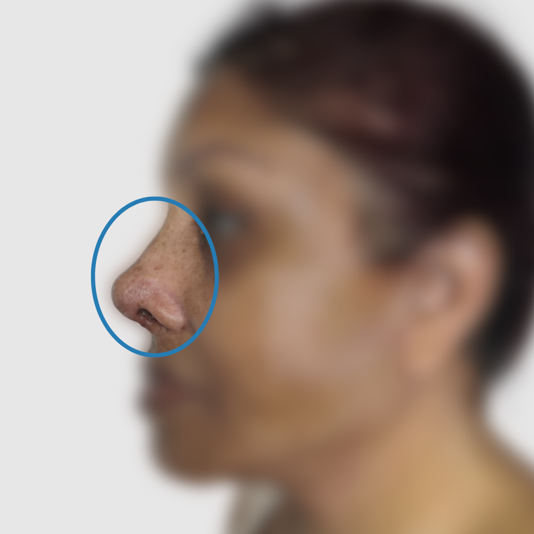 After-Rinoplastia