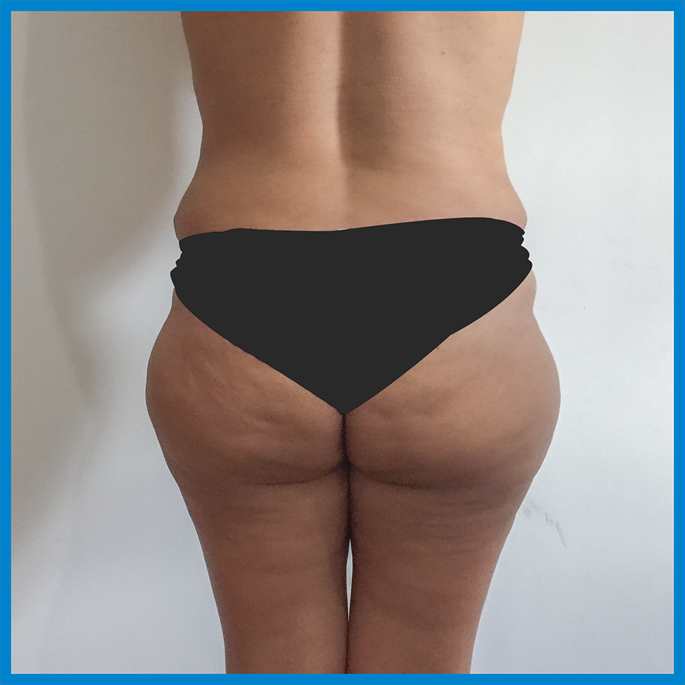 Before-Lipoescultura