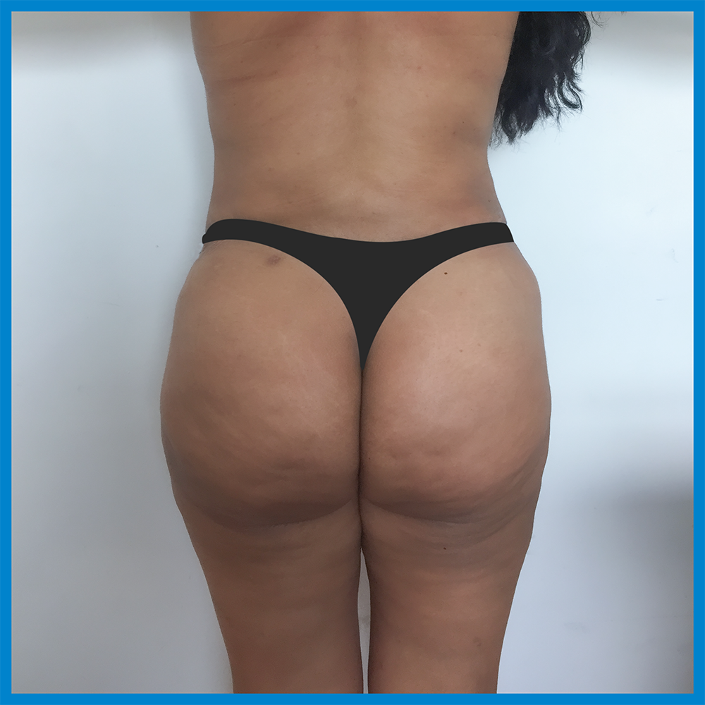 After-Lipoescultura
