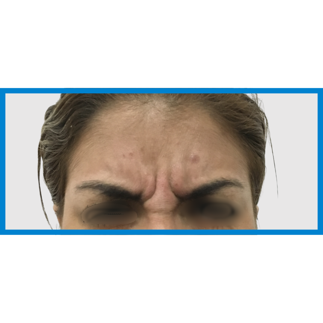 Before-Entrecejo