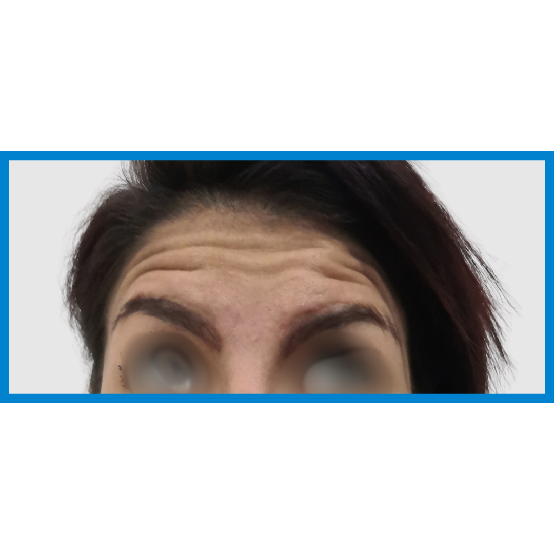 Before-Frente