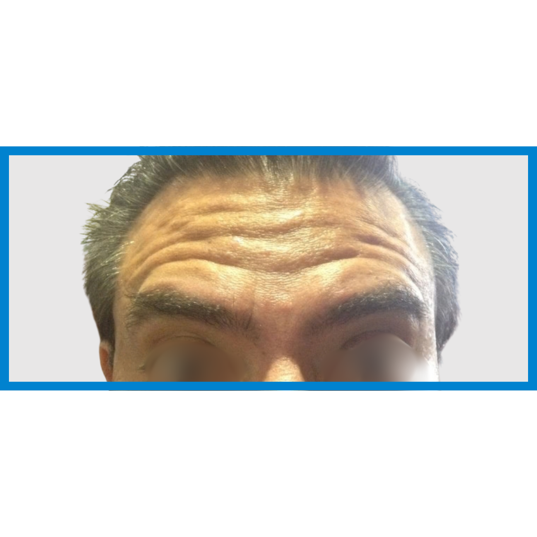 Before-Frente