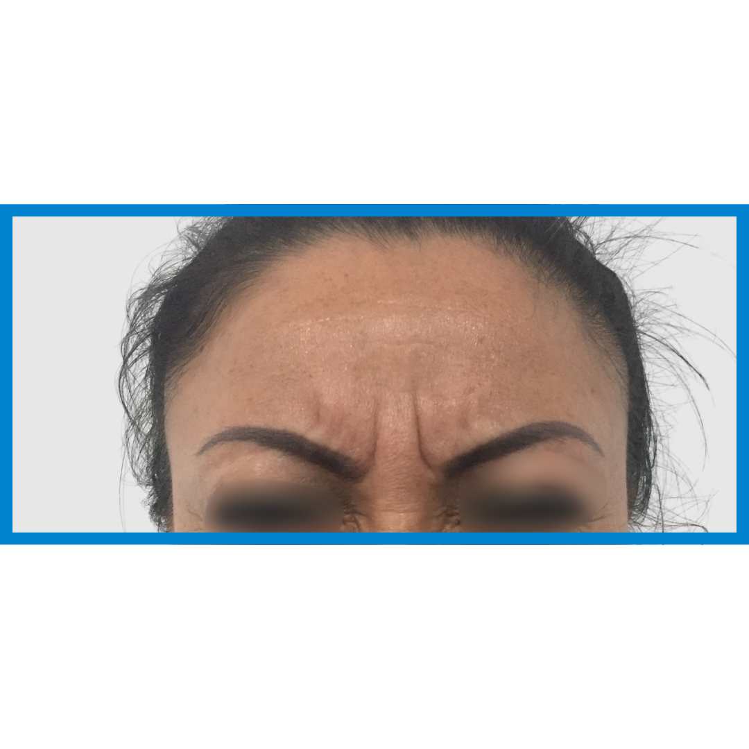 Before- Entrecejo