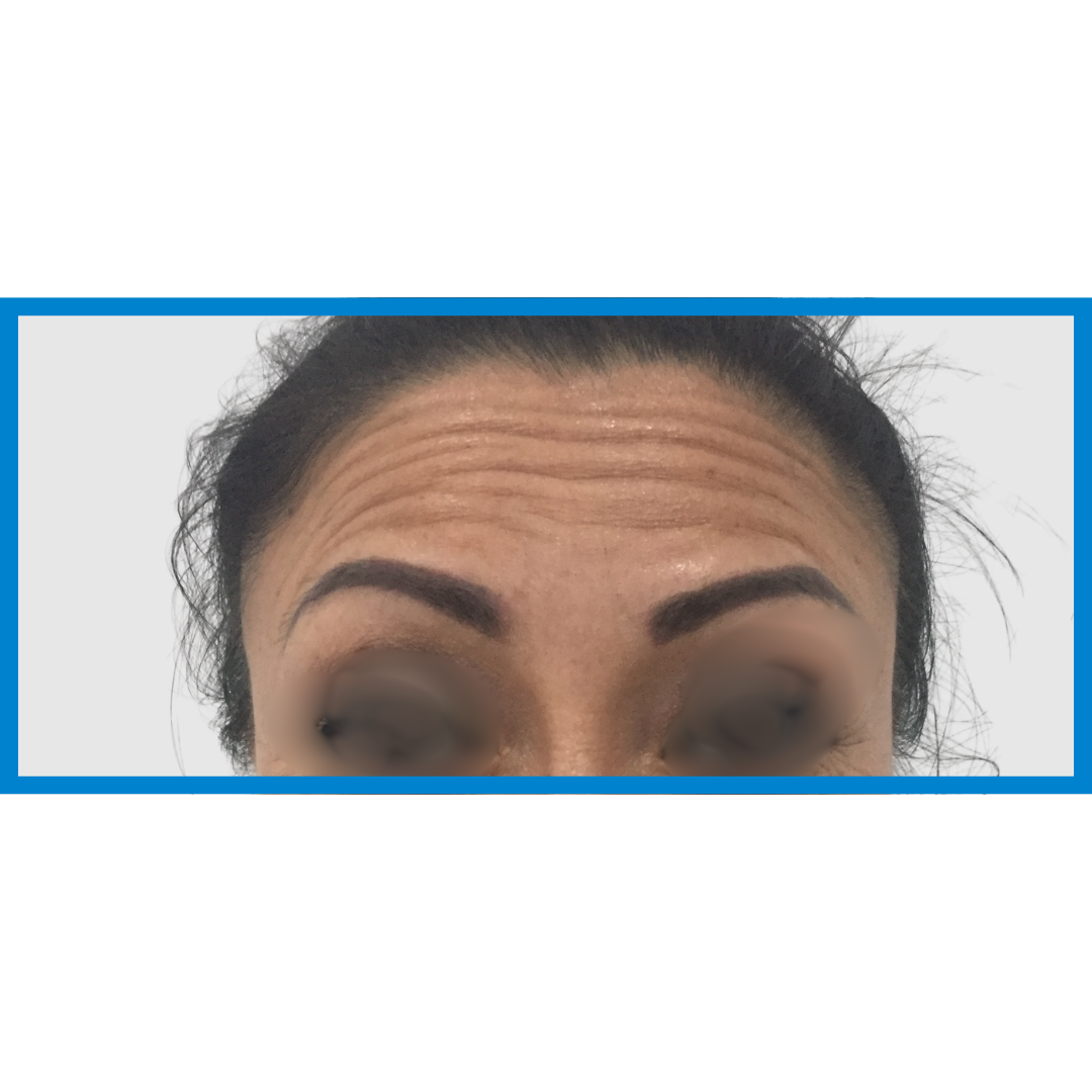 Before-Frente