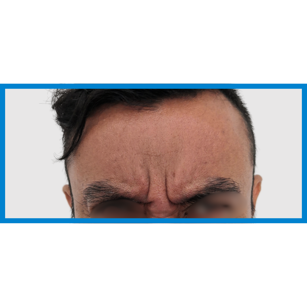 Before-Entrecejo