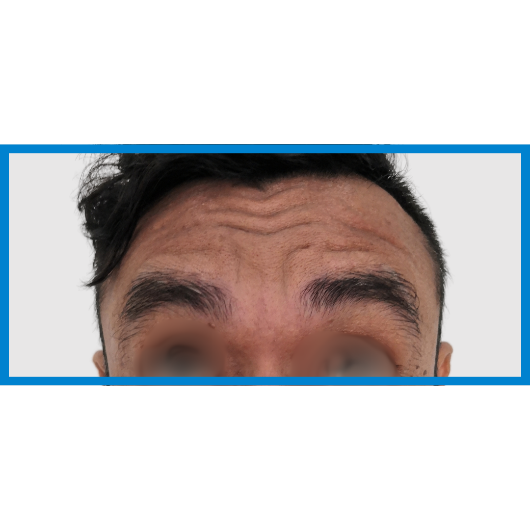 Before-Frente