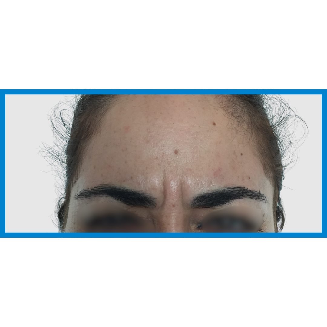 Before-Entrecejo