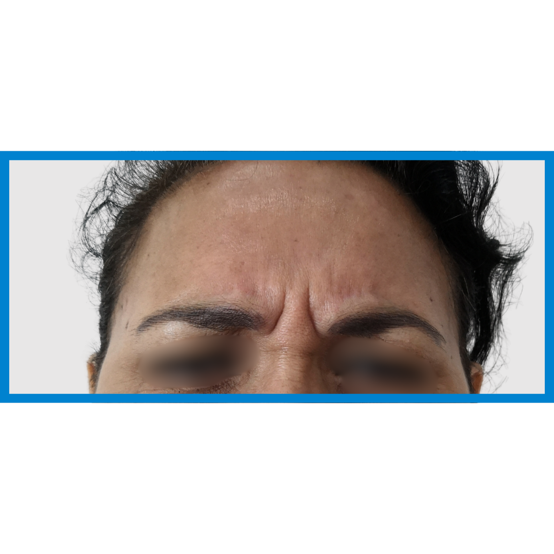 Before-Entrecejo