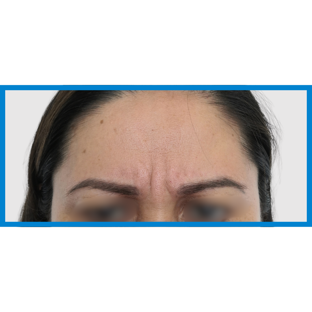 Before-Entrecejo