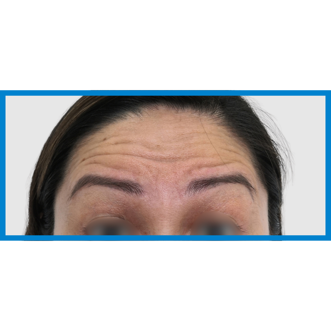 Before-Frente
