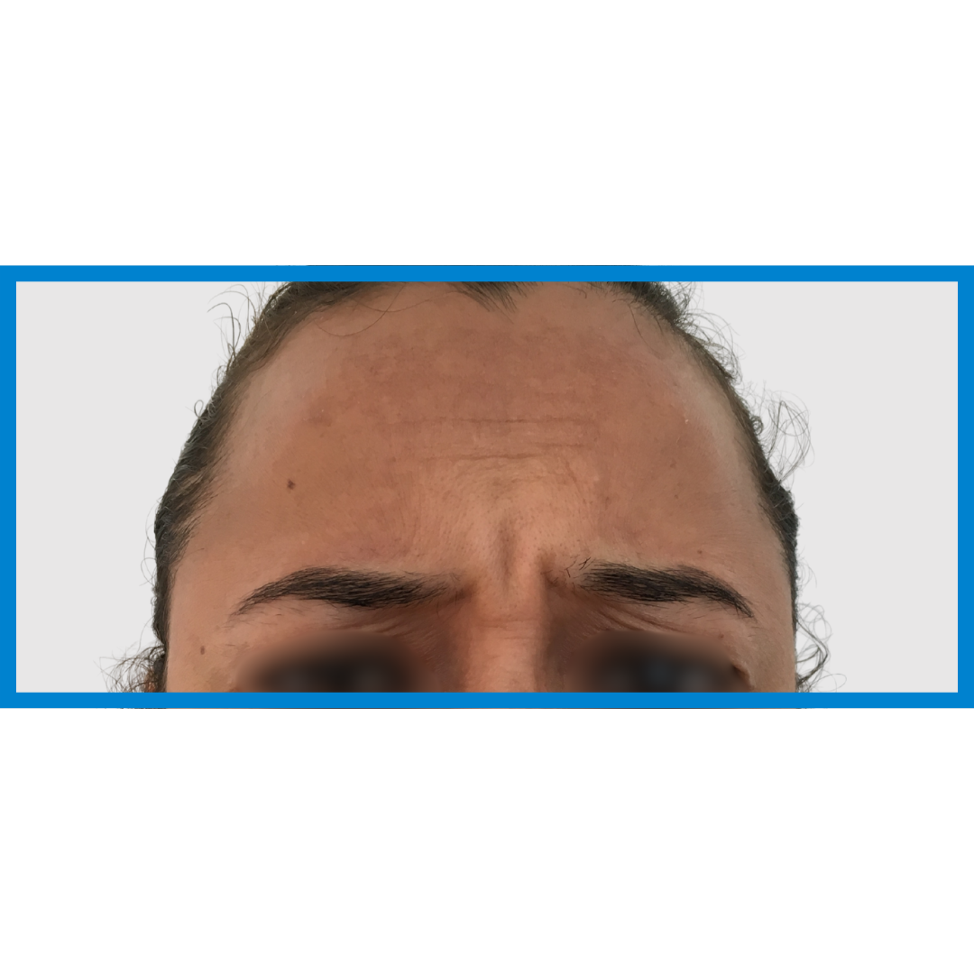 Before-Entrecejo
