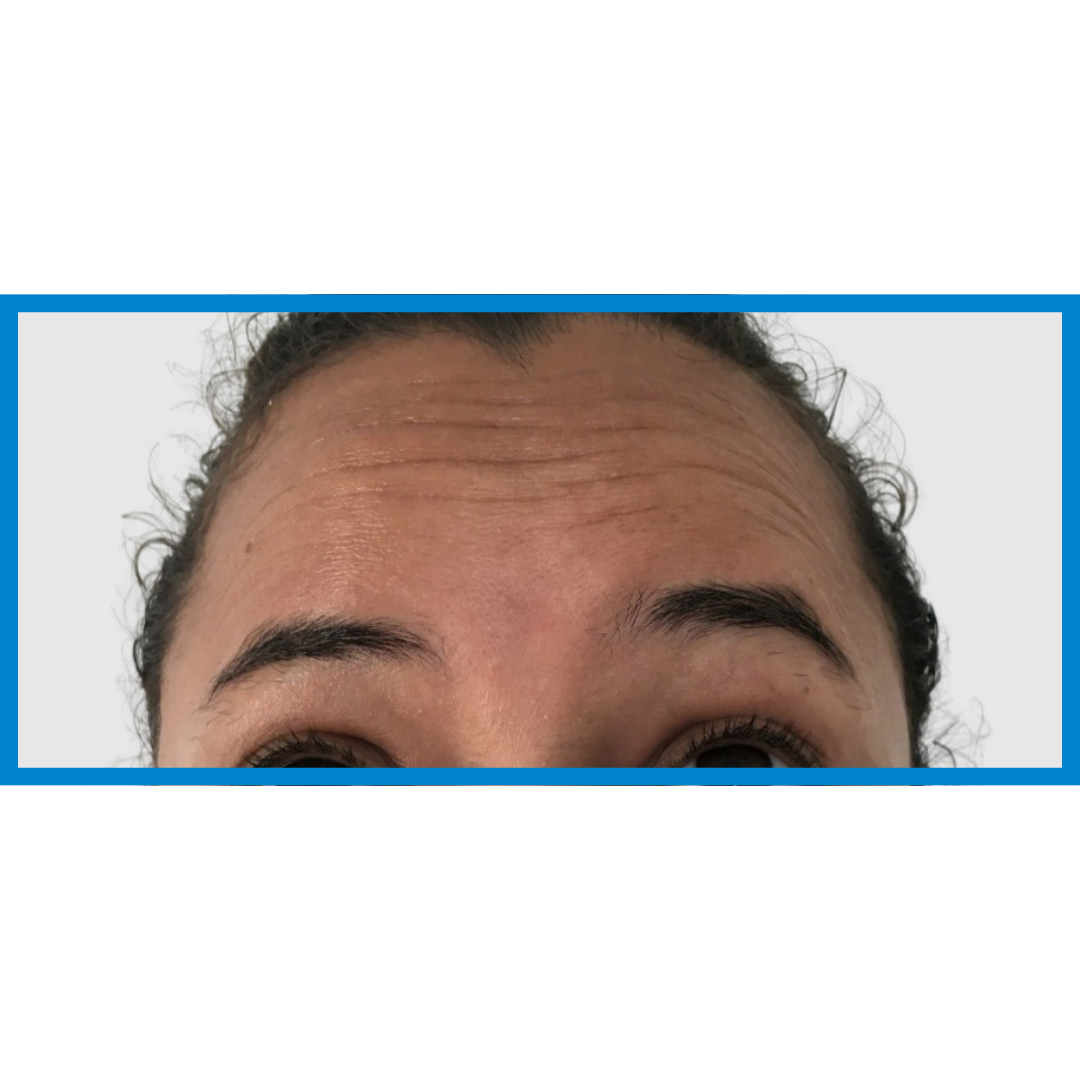 Before-Frente