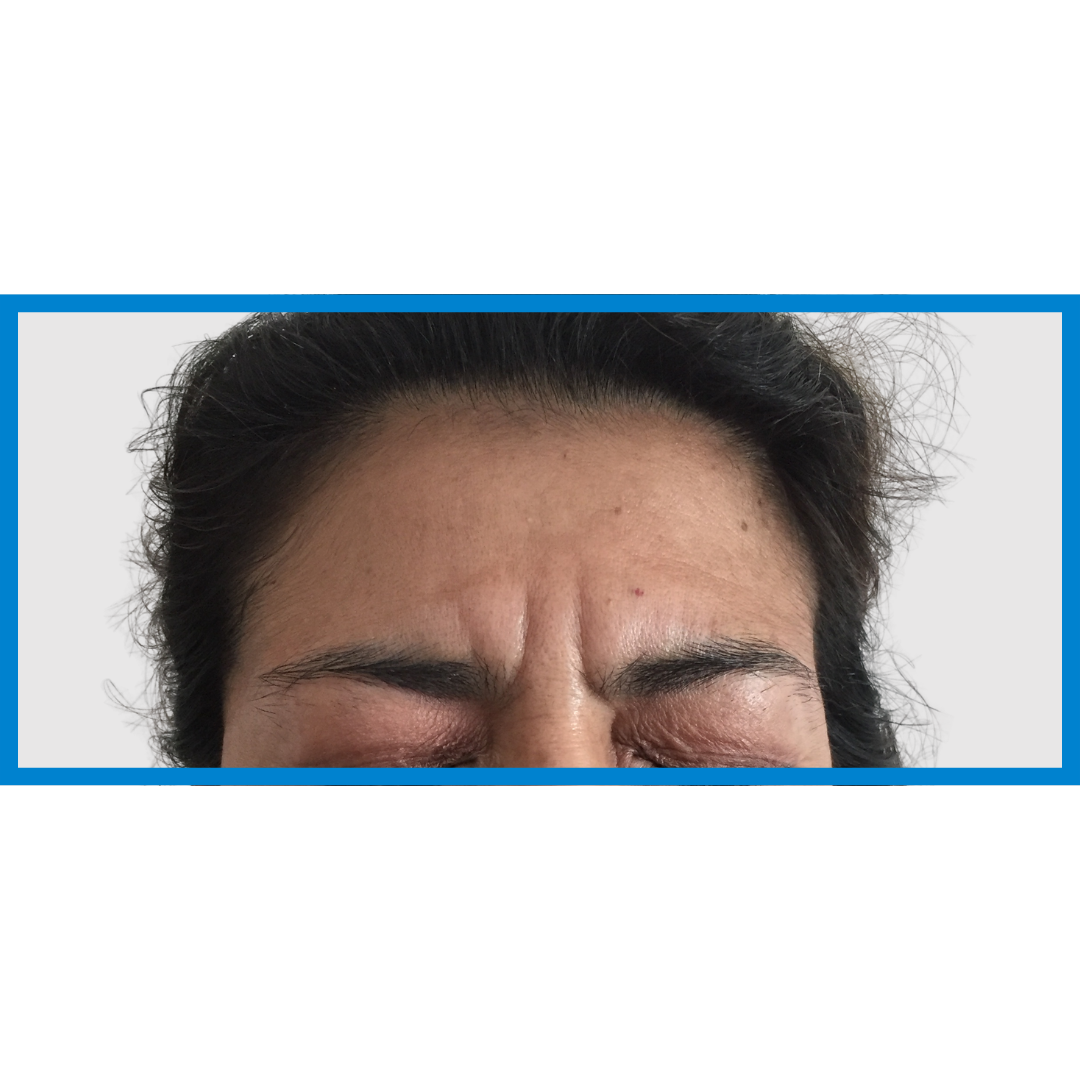 Before-Entrecejo