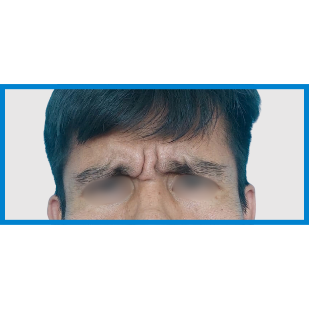 Before-Entrecejo