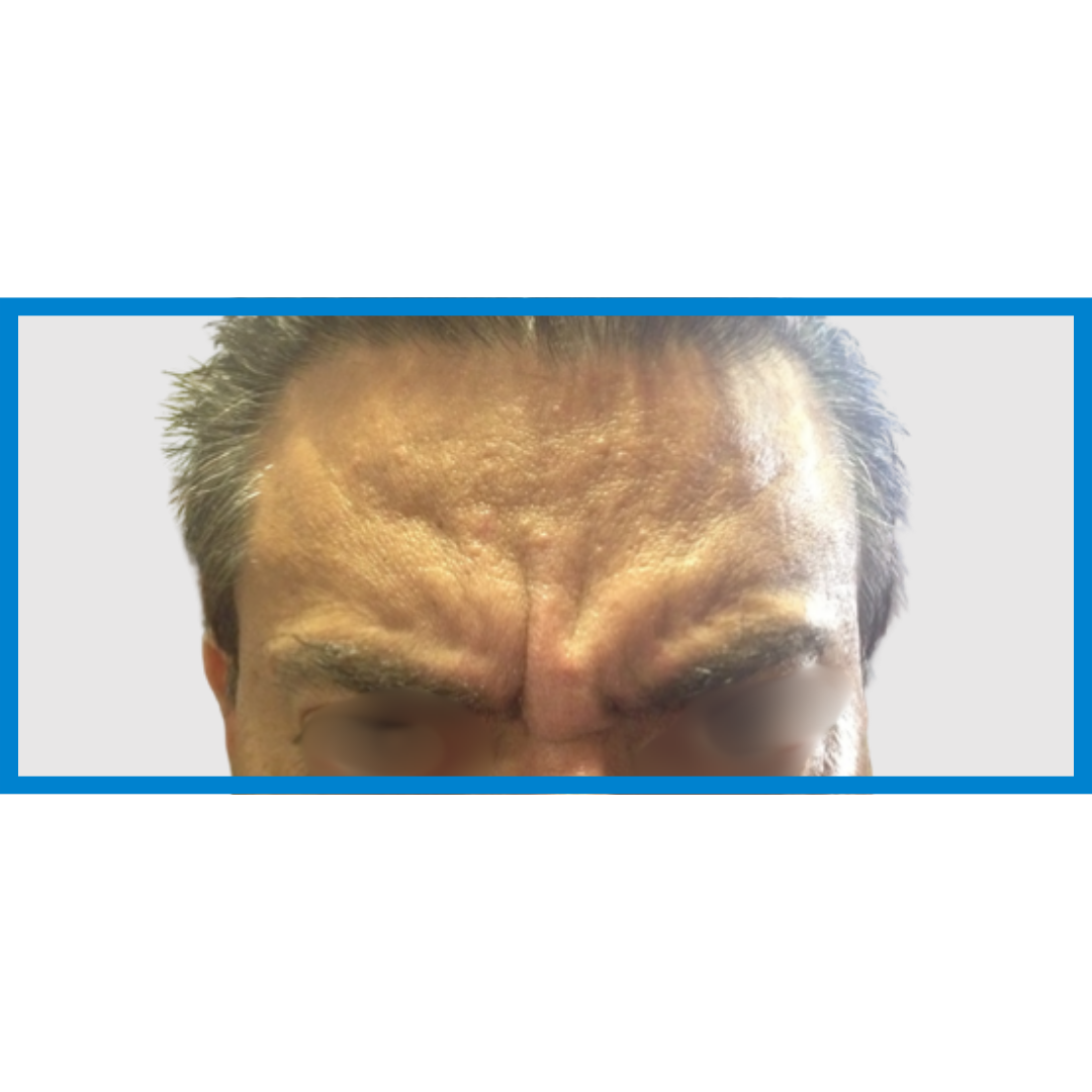 Before-Entrecejo