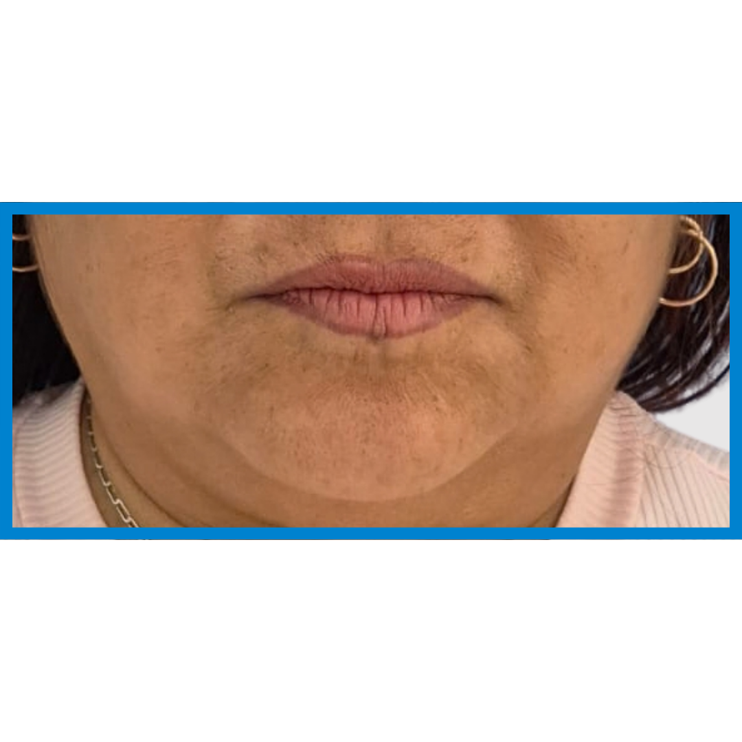 Before-Labios