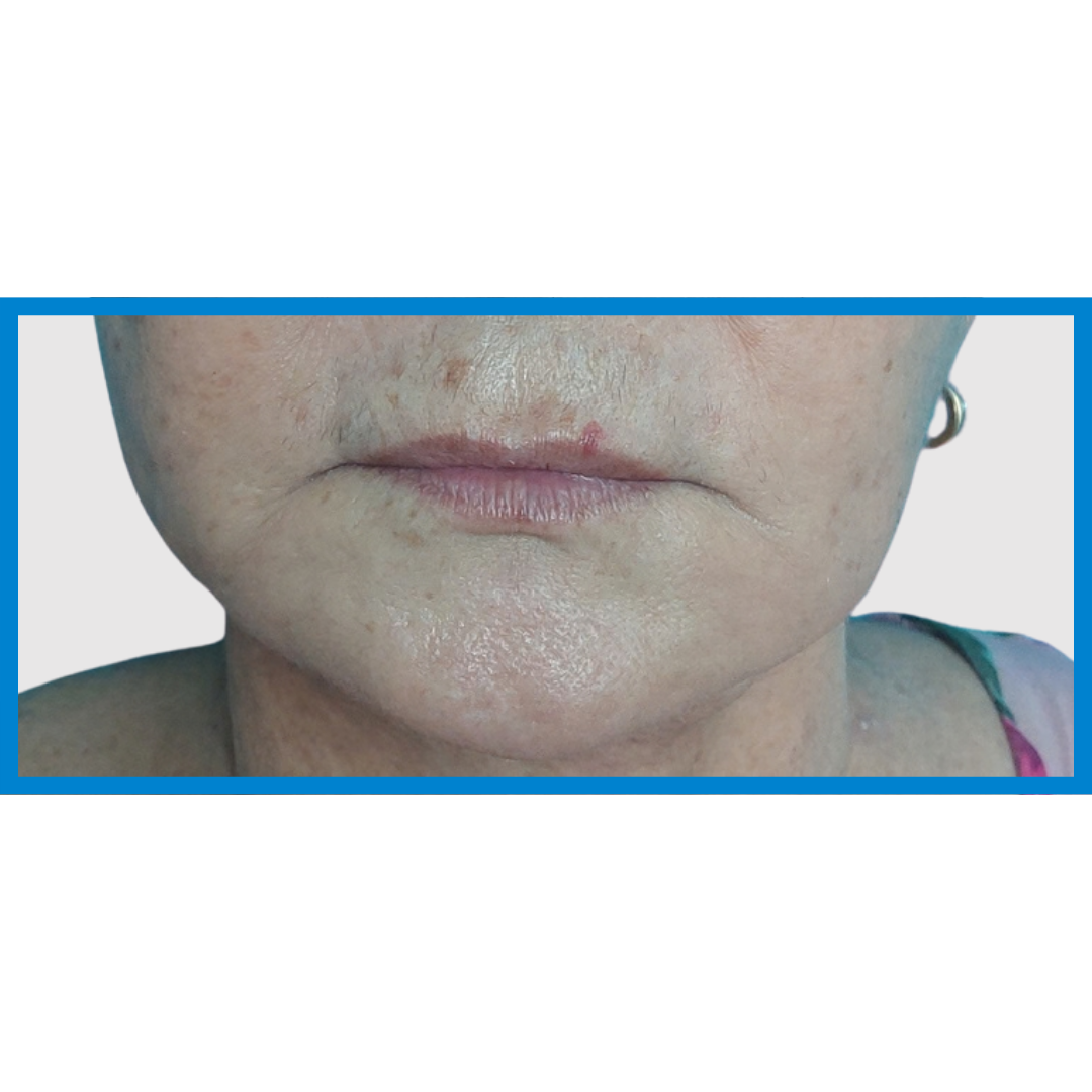 Before-Labios