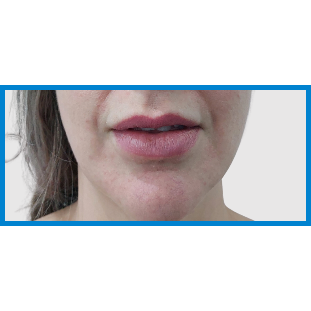 Before-Labios