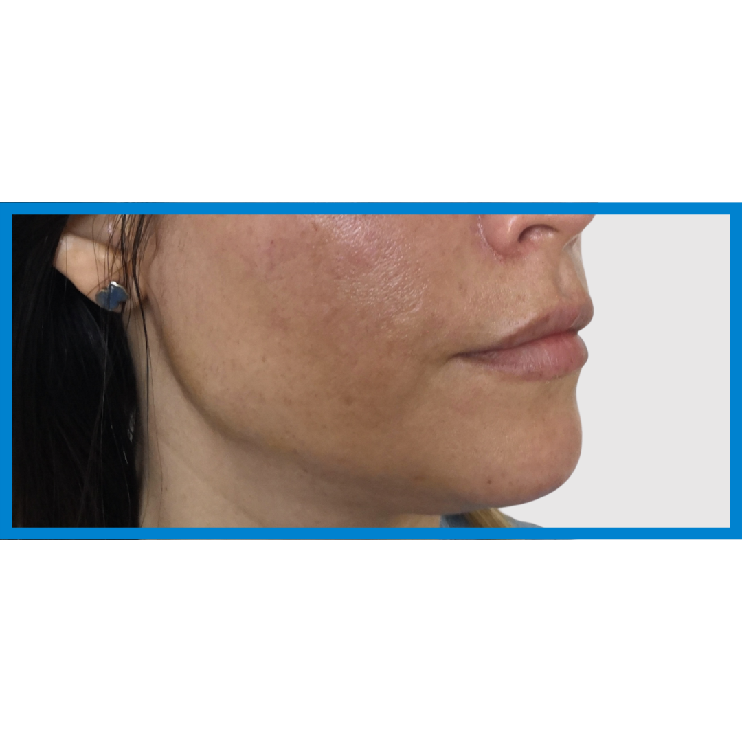 After-Línea Mandibular 