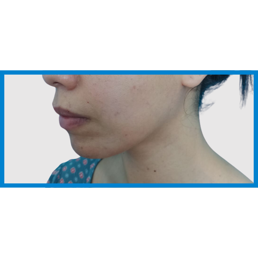 Before-Linea Mandibular