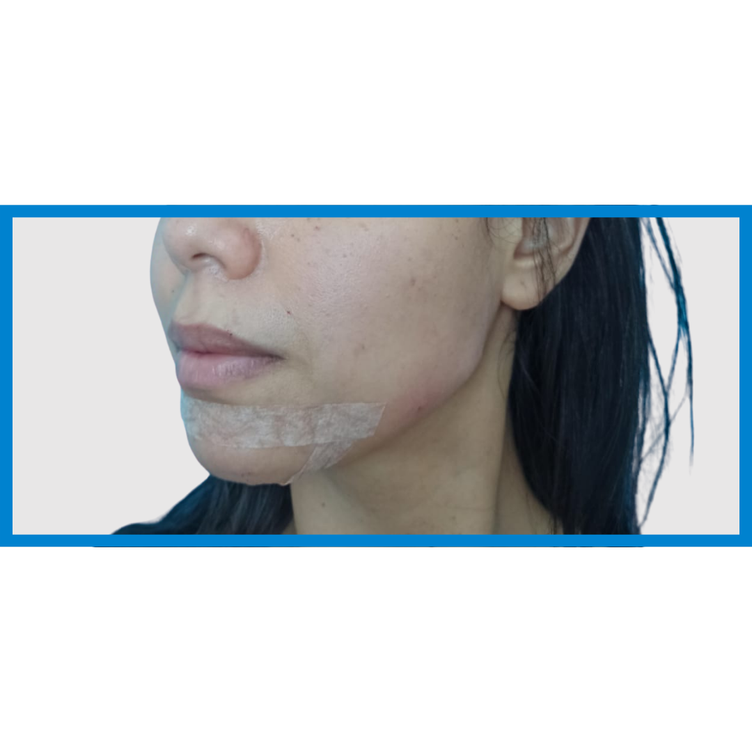 After-Linea Mandibular