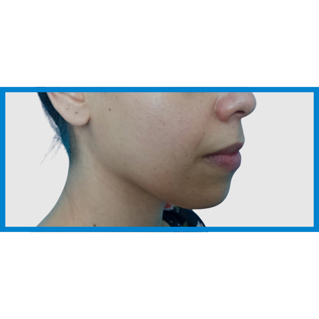 Before-Linea Mandibular